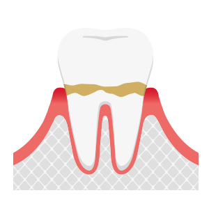 歯周病中等度