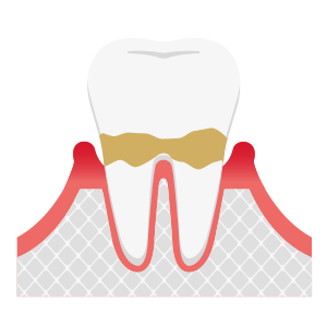 歯周病軽度